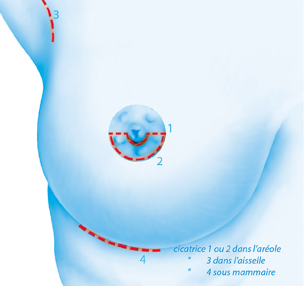 Chirurgie esthétique résuction des seins par le Docteur Weiss du CCEPO 